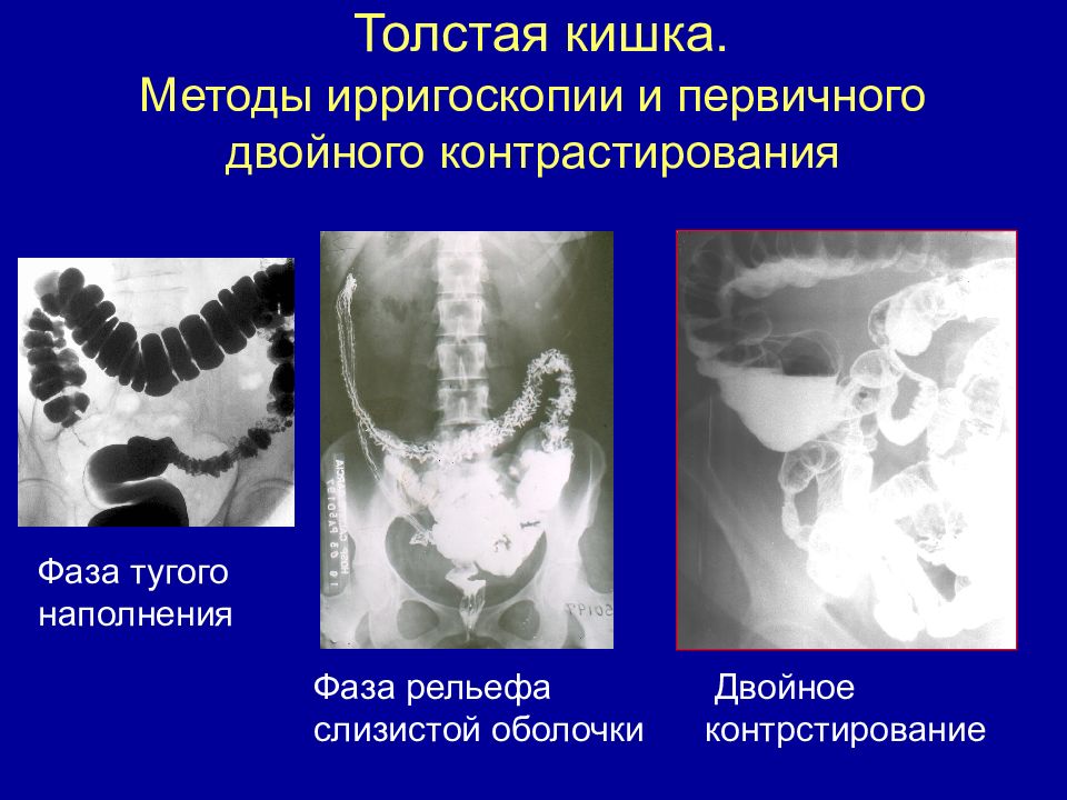 Чем отличается ирригоскопия. Контрастирование Толстого кишечника рентген. Ирригоскопия фаза тугого наполнения. Толстая кишка двойное контрастирование. Травмы Толстого кишечника рентген.