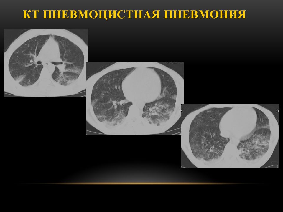 Пневмоцистная пневмония кт картина