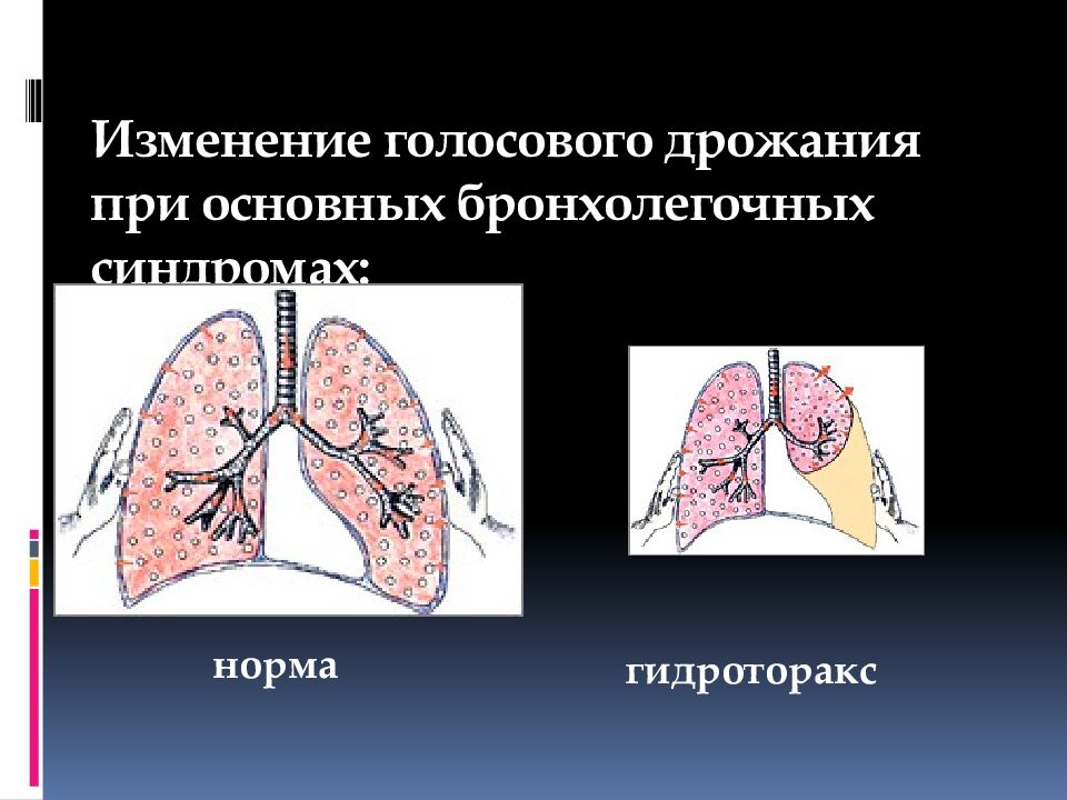 Голосовое дрожание. Гидроторакс пропедевтика. Гидроторакс аускультативно. Голосовое дрожание при гидротораксе.