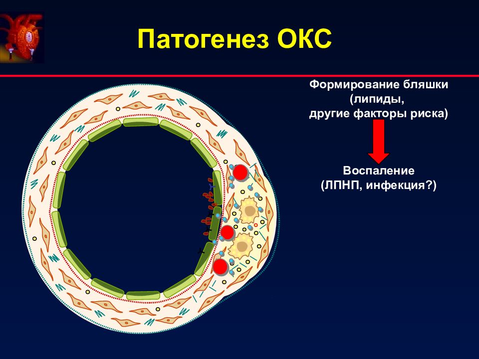 Острый коронарный синдром картинки