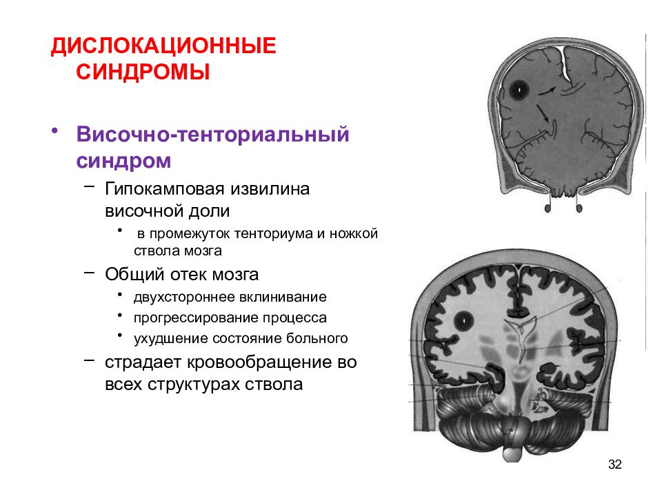 Опухоли цнс презентация