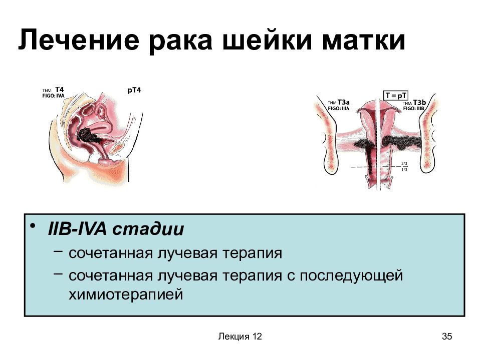 Рак шейки матки онкология презентация