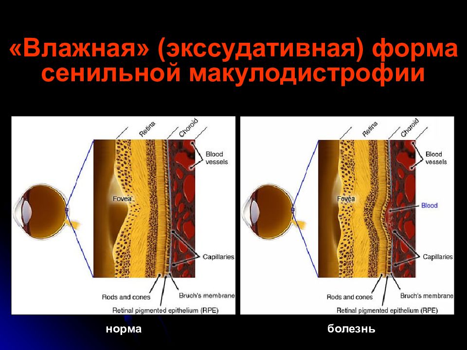 Возрастная макулярная дегенерация презентация