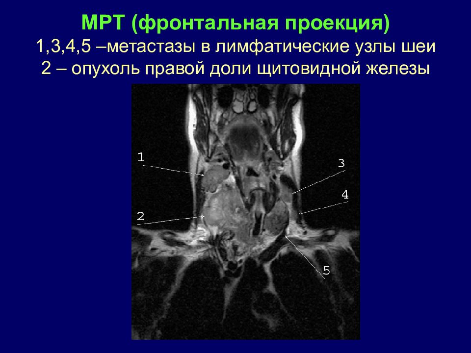 Метастатические лимфоузлы. Кт мрт щитовидной железы. Лимфатические узлы мягких тканей шеи кт. Щитовидная железа мрт анатомия. Метастазы в лимфоузлы шеи мрт.