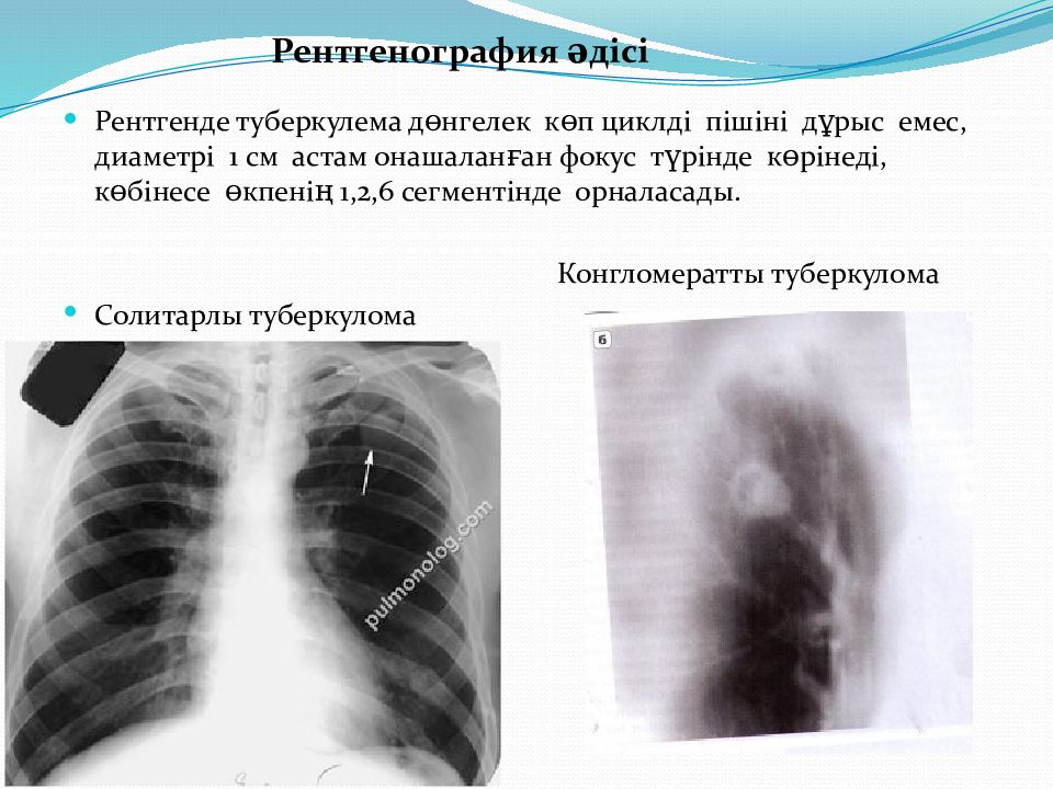 Презентация туберкулема легких