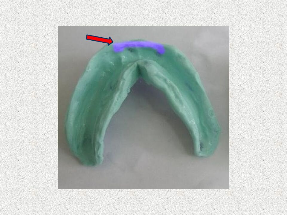 Funksional otisklar uchun individual qoshiqchalar