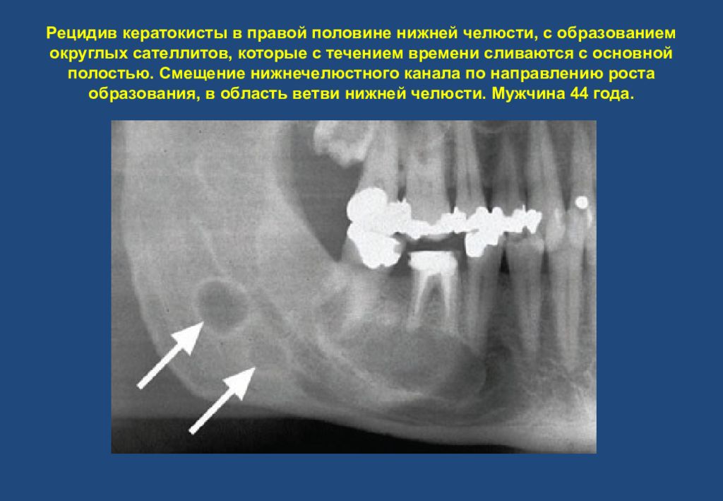 Удаление опухоли рецидивы