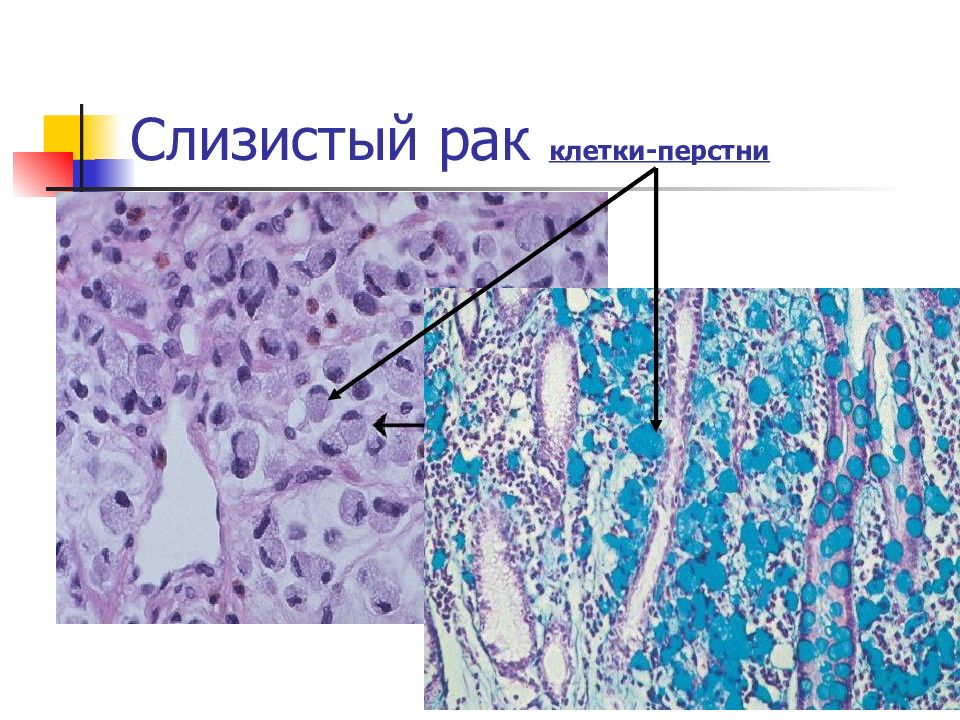 Солидный рак