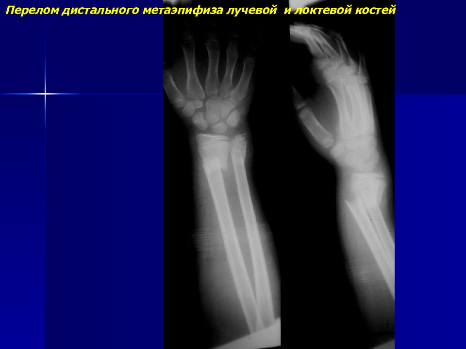 Перелом дистального метаэпифиза лучевой кости