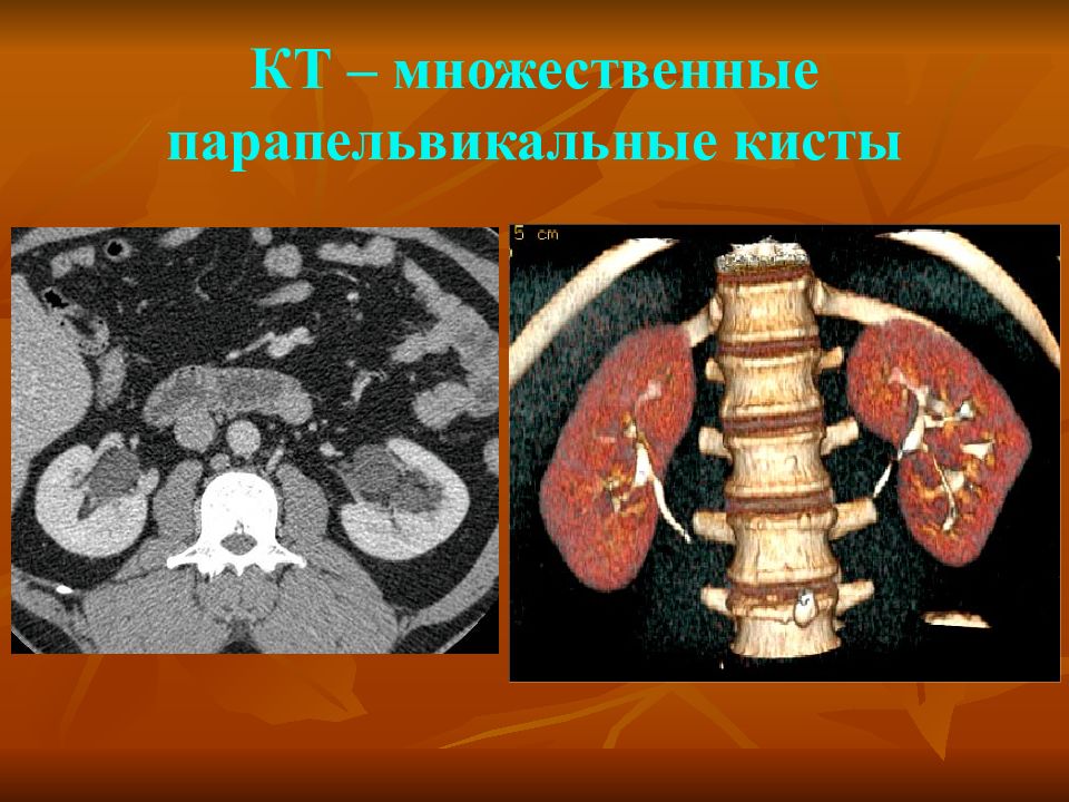 Киста левой почки. Парапельвикальная киста почки кт. Парапельвикальные кисты почек на кт. Перипельвикальные кисты почек на кт. Парапельвикальные кисты почек что это такое.