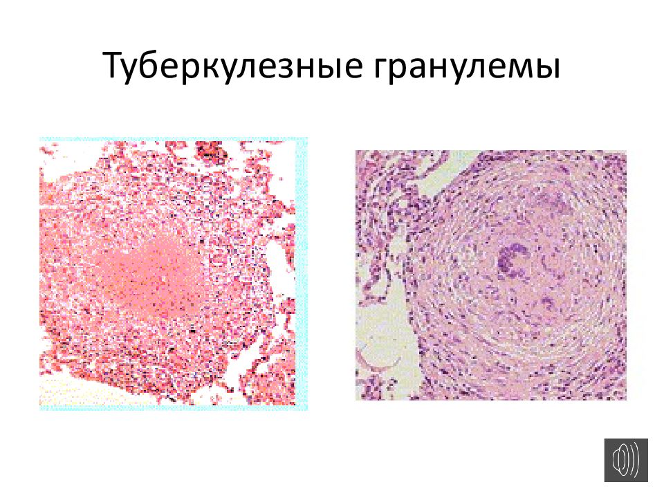 Туберкулезная гранулема рисунок