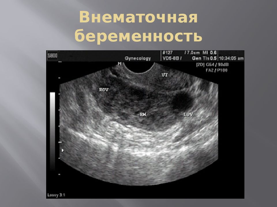 Внематочная эндометрий. Внематочная беременность. Трубная беременность УЗИ. Внематочная беременность на УЗИ. УЗИ внематочной беременности в брюшной полости.