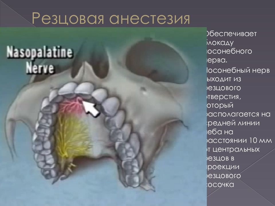 Резцовый. Блокада носонебного нерва. Резцовый нерв верхней челюсти. Резцовая анестезия верхней челюсти. Обезболивание носонебного нерва.