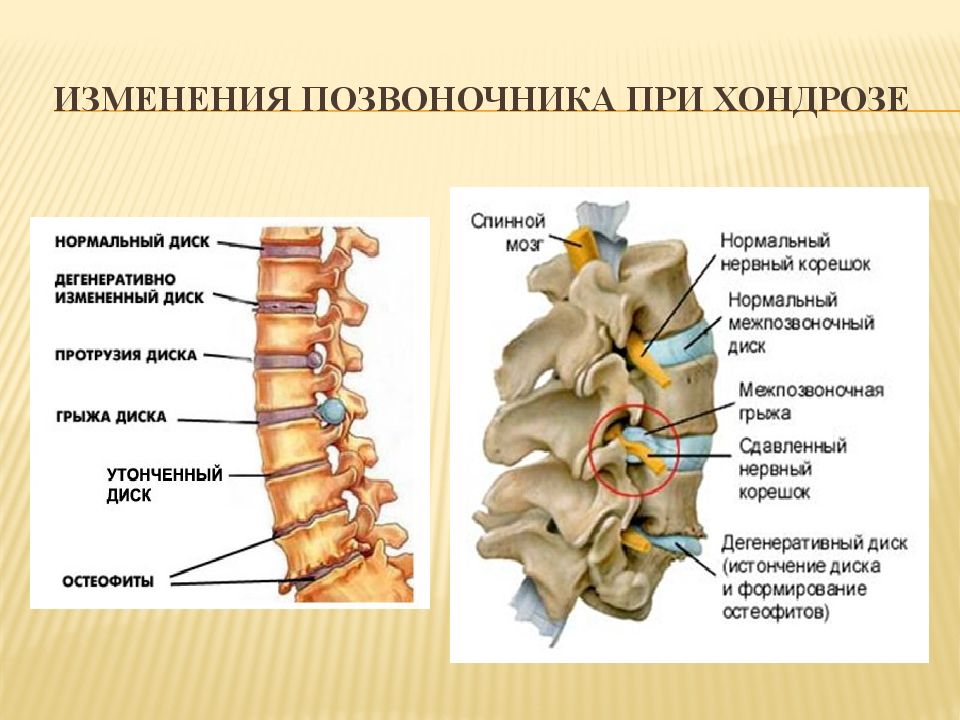 Грудной хондроз симптомы. Хандроз грудного отдела позвоночника. Клиника остеохондроза грудного отдела позвоночника. Дегенеративные изменения позвоночника. Дегенеративные изменения грудного отдела позвоночника.