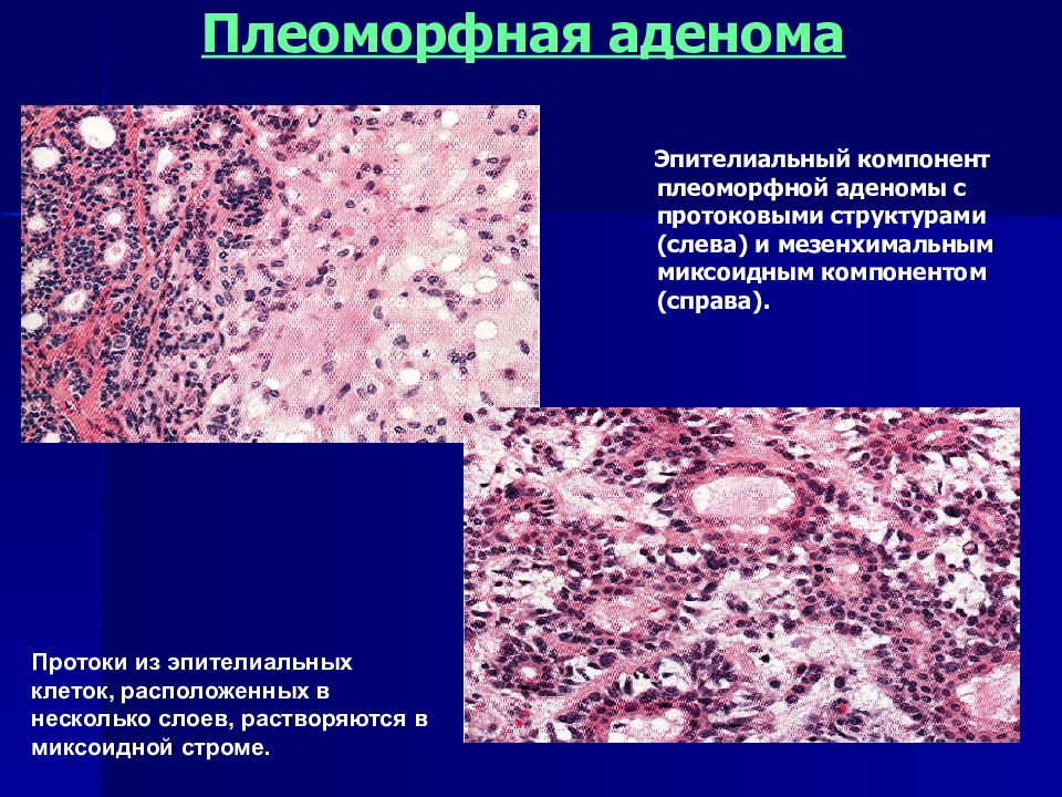 Рецидив аденомы