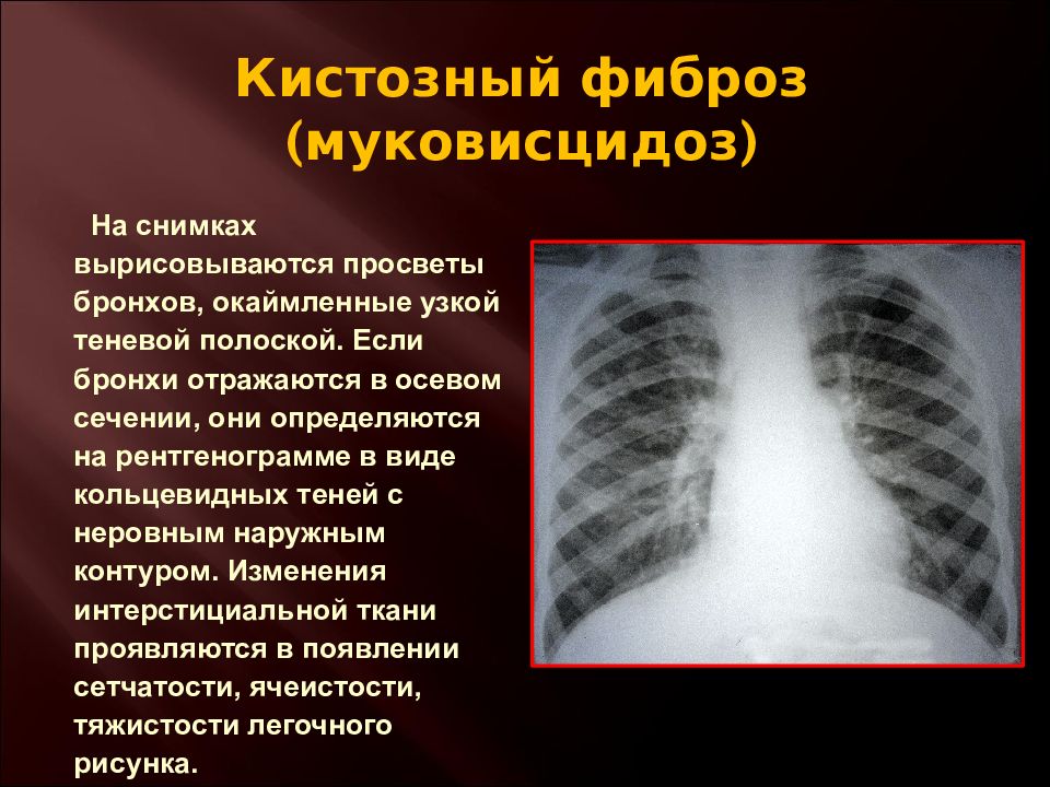 Кистозный фиброз. Муковисцидоз кистозный фиброз.