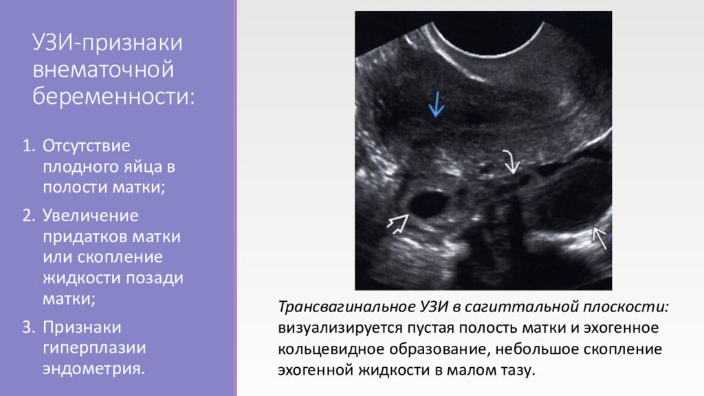 Внематочная эндометрий. Внематочная беременность на УЗИ. Эктопическая беременность УЗИ. Внематочная беременность УЗИ признаки. Внематочная беременность симптомы.