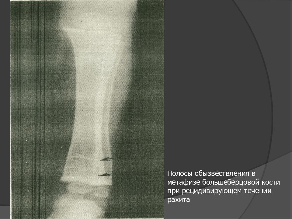 Обызвествление. Рахит обызвествление костей. Обызвествление костного мозга рентген. Рентгенологическая картина рахита.