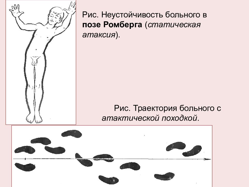 Неустойчивость. Неустойчивость в позе ромберга. Статическая атаксия поза ромберга. Атаксия в позе ромберга. Поза ромберга пошатывание.