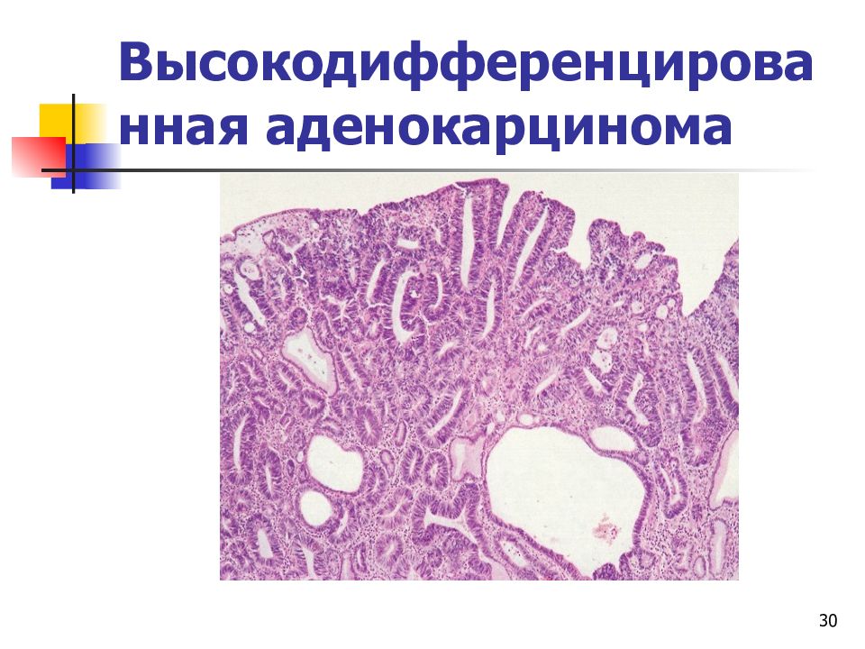 Аденокарцинома что это. Аденокарцинома макропрепарат. Высокодифференцированная аденокарцинома. Высокодифференцированная аденокарцинома эпителия. Тубулярная аденокарцинома желудка.