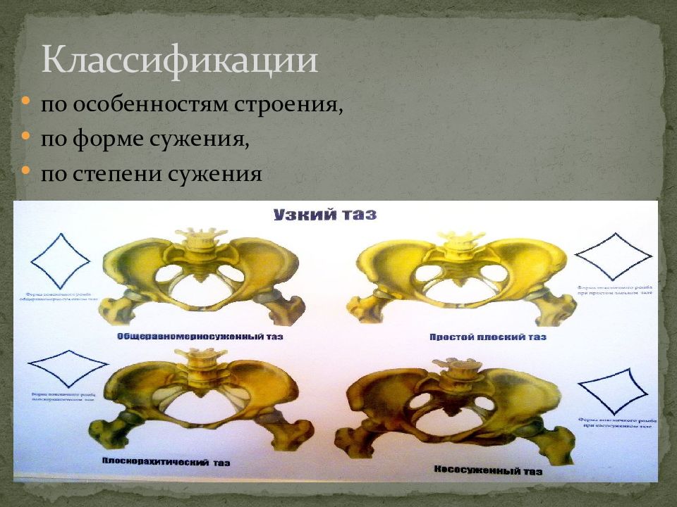 Презентация аномалии костного таза