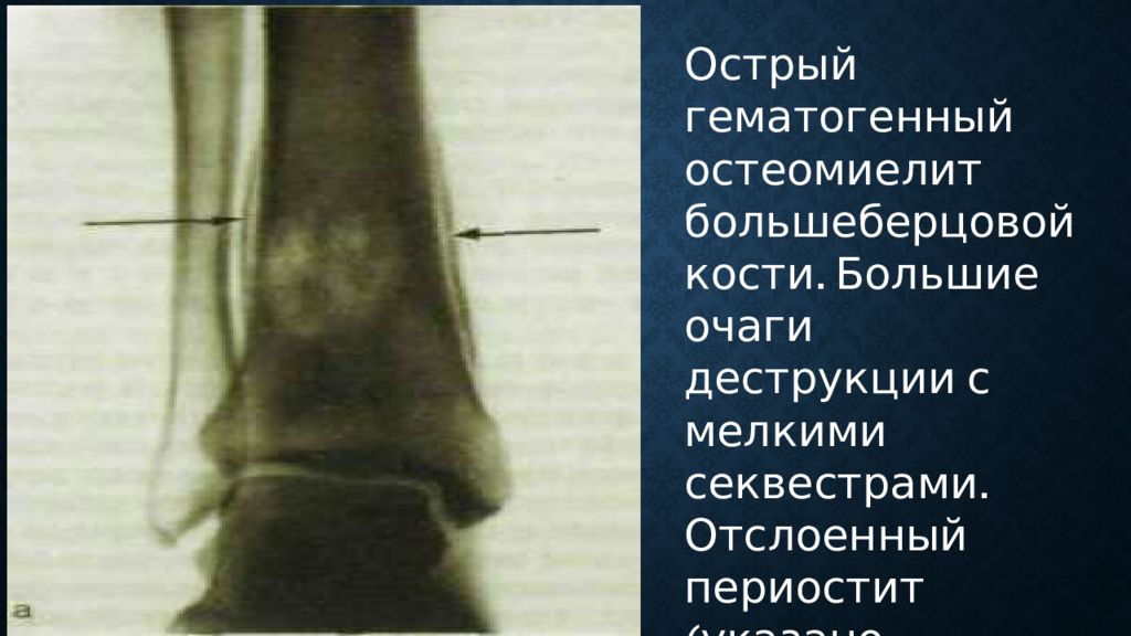 Исследование кости. Острый остеомиелит большеберцовой кости. Секвестры при остеомиелите. Остеомиелит с наличием секвестральных полостей. Остеомиелической деструкции.