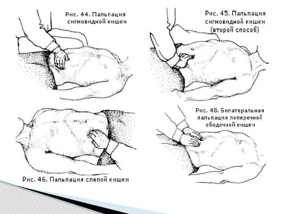 Пальпировать. Пальпация сигмовидной и слепой кишки. Глубокая пальпация сигмовидной кишки. Поверхностная пальпация кишечника. Глубокая пальпация Толстого кишечника.
