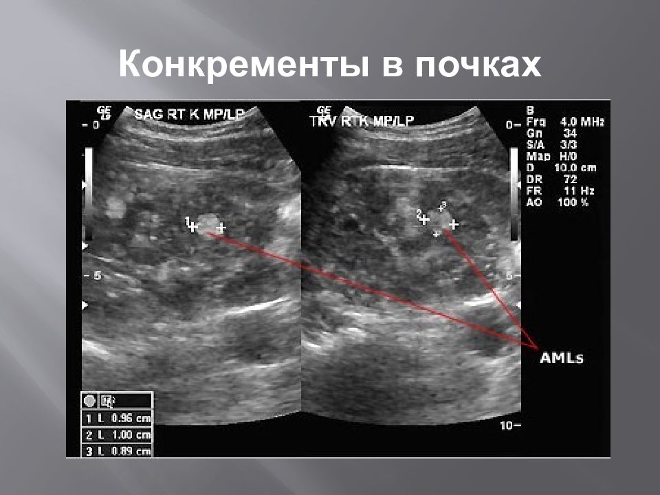 Узи картина мочекаменной болезни