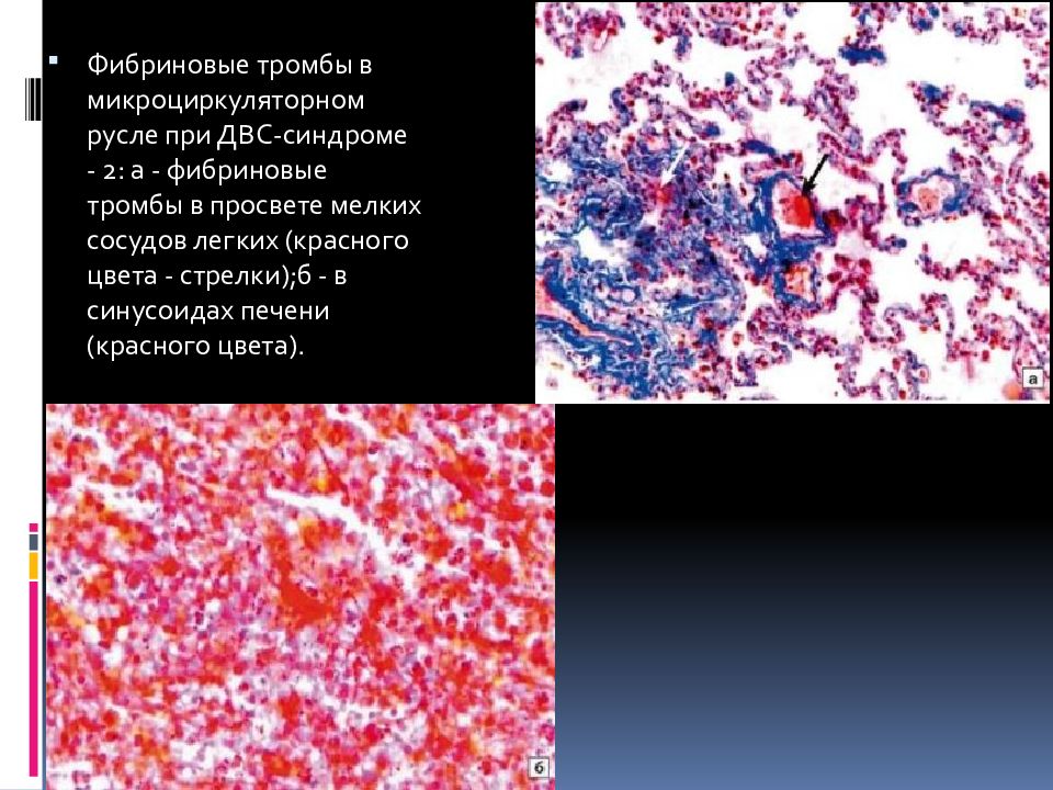 Чума патологическая анатомия презентация