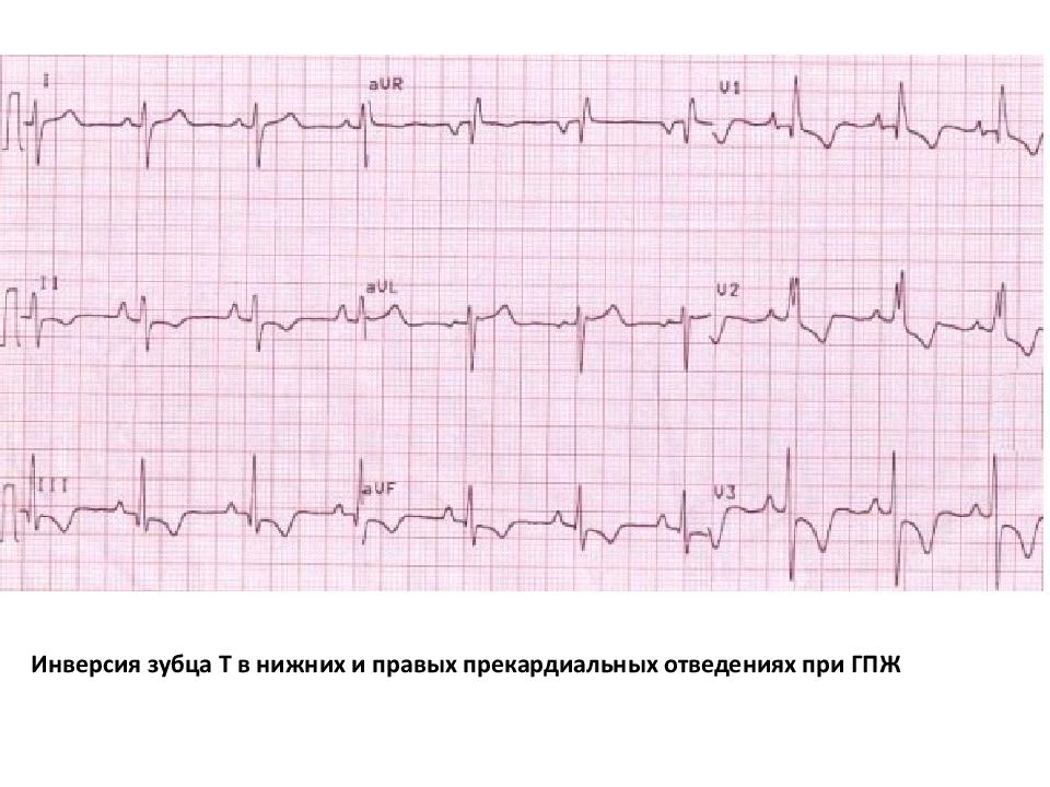 Экг презентация терапия