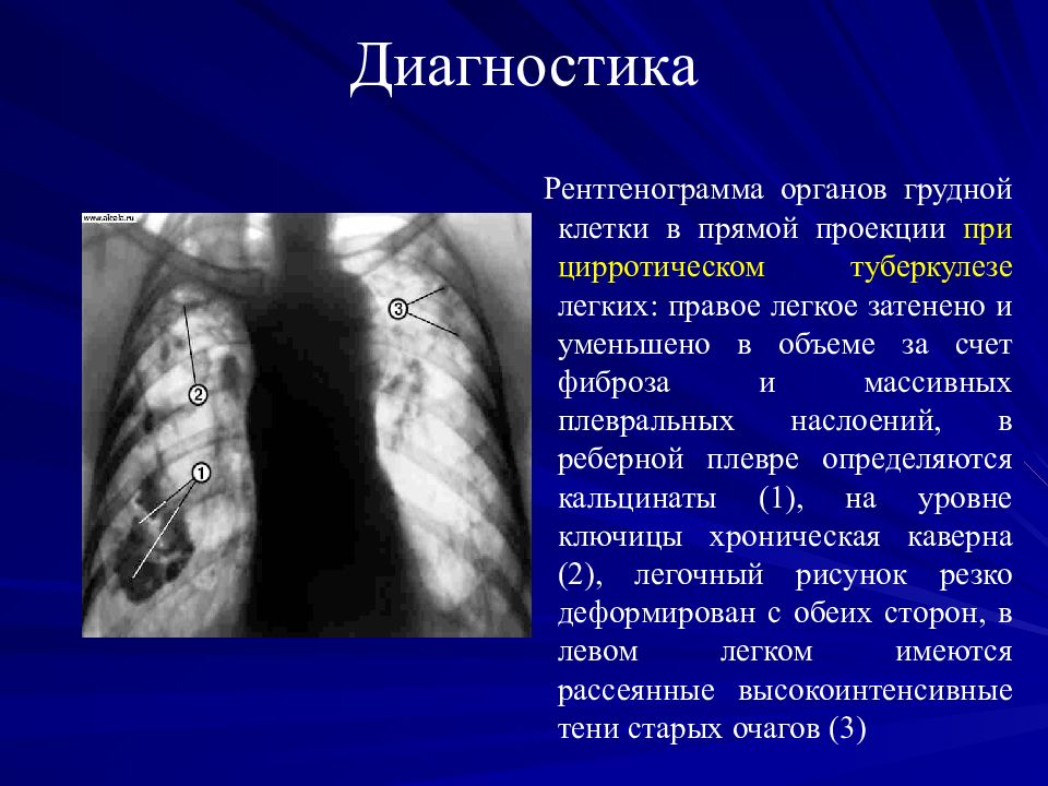 Презентация по фтизиатрии