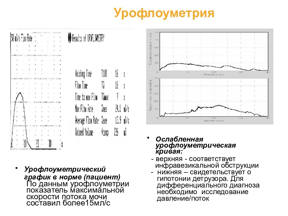 Урофлоуметрия как проводится. Урофлоуметрия показатели. Урофлоуметрия нормальные показатели. Урофлоуметрия показатели нормы. График урофлоуметрии нормальный.