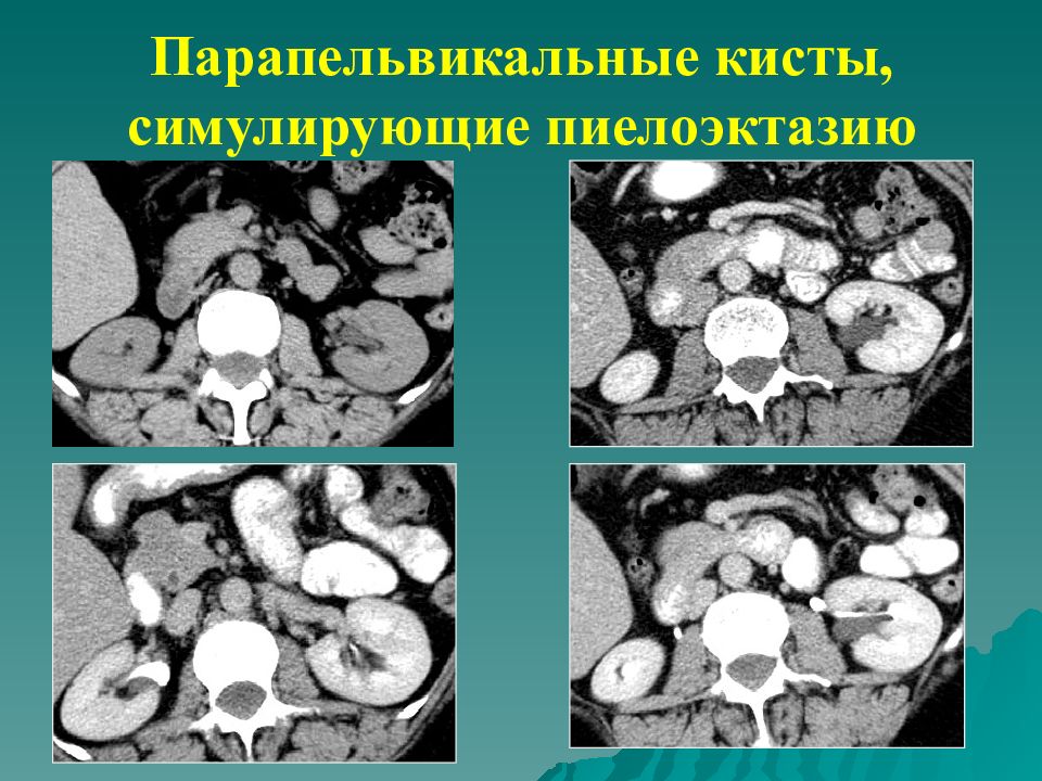 Парапельвикальные кисты почек