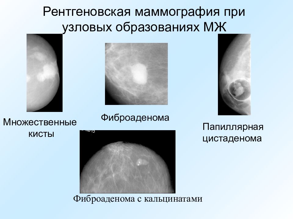 Доброкачественное образование молочных желез. Фиброаденоматоз рентген маммография. Фиброаденома молочной железы маммография. Обызвествленная фиброаденома молочной железы маммография. Киста маммография снимки.