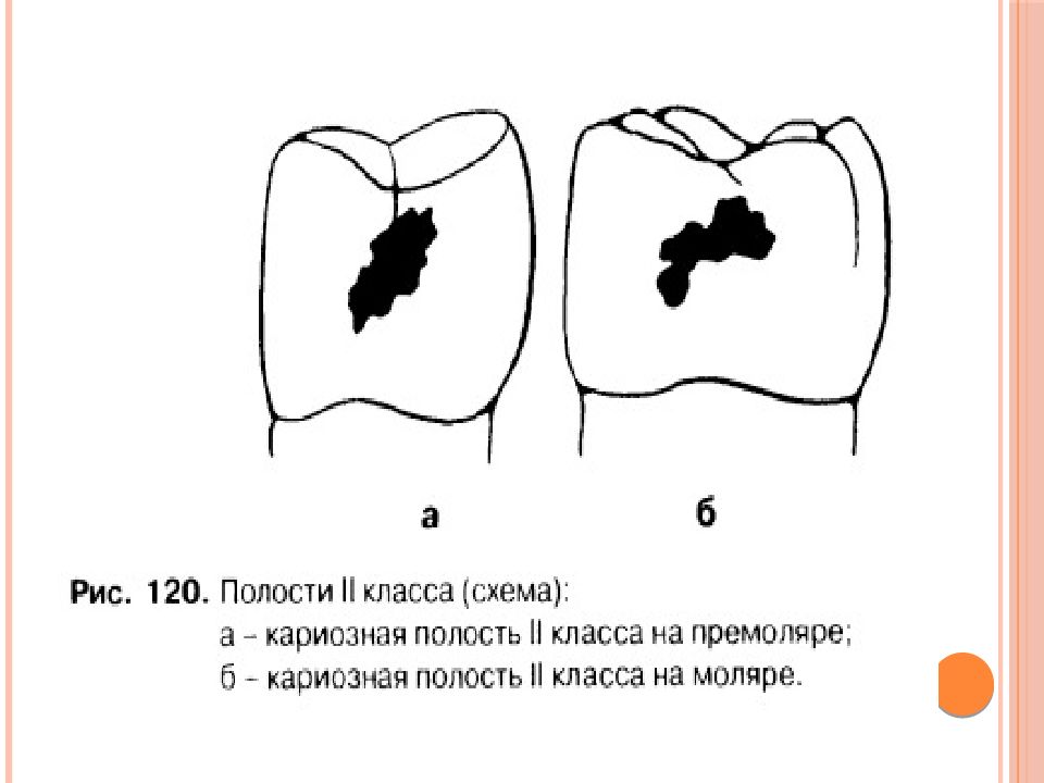 Придесневая стенка кариозной полости