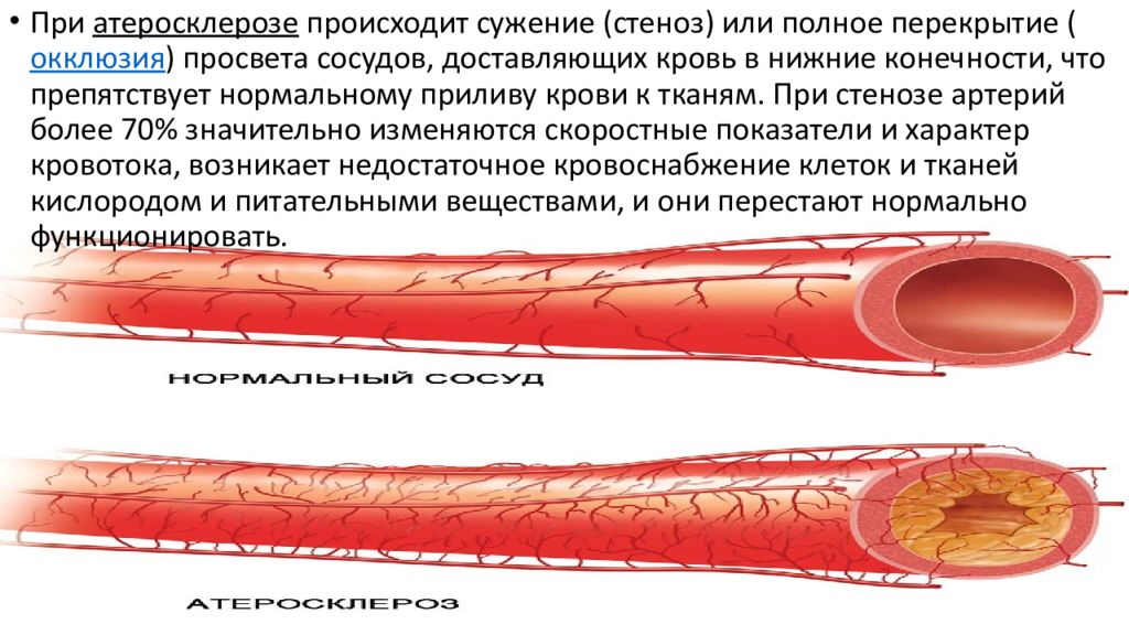 Расширение артериальных сосудов. Атеросклероз венечных артерий сердца. Атеросклероз (закупорка кровеносных сосудов). Сужение просвета сосудов. Атеросклеротическое поражение сосудов.