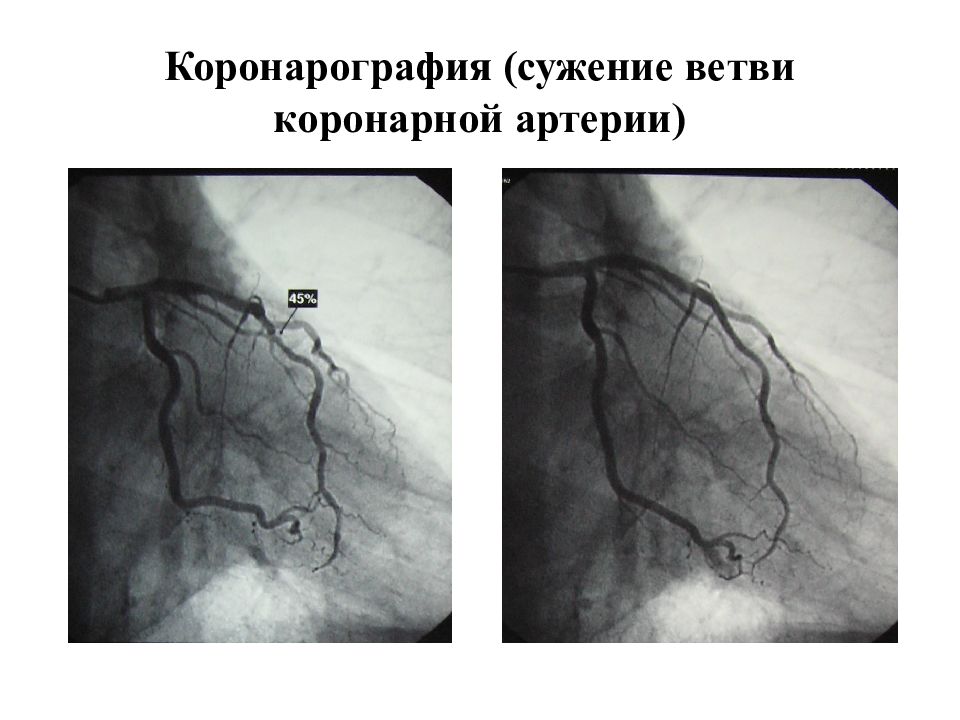 Коронарография в нижнем