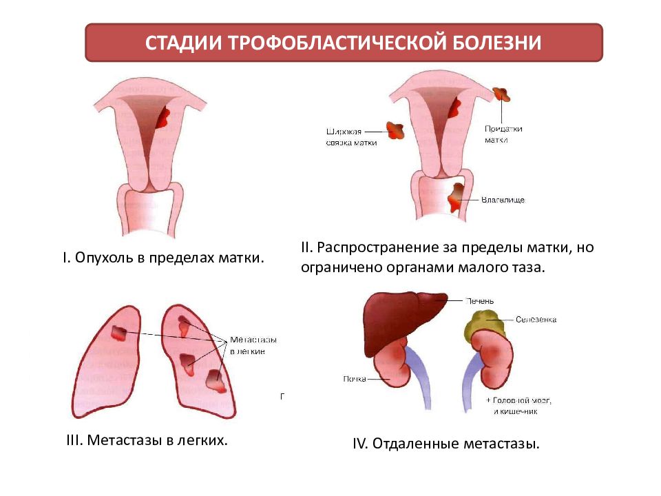 Трофобластическая болезнь гинекология презентация