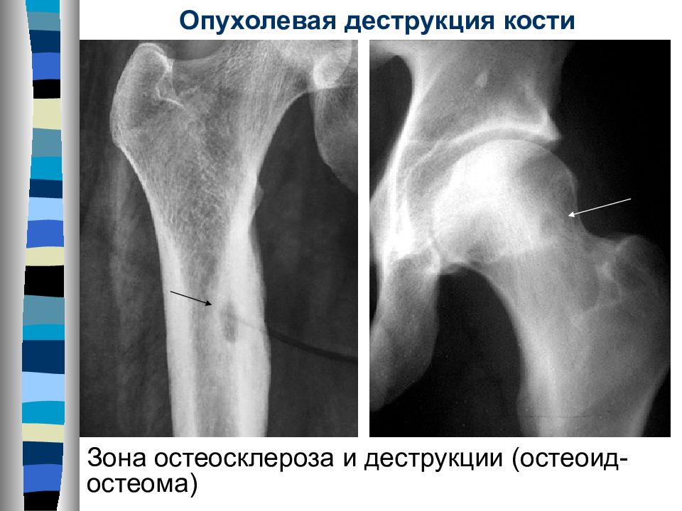 Остеосклеротические очаги в костях