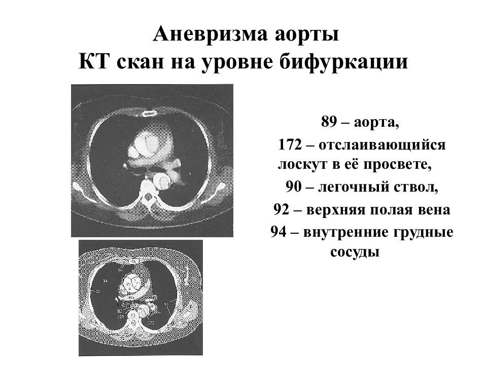 Легочный ствол на кт. Диаметр легочных артерий в норме на кт. Норма легочных артерий на кт. Легочной ствол анатомия кт. Легочной ствол на кт.