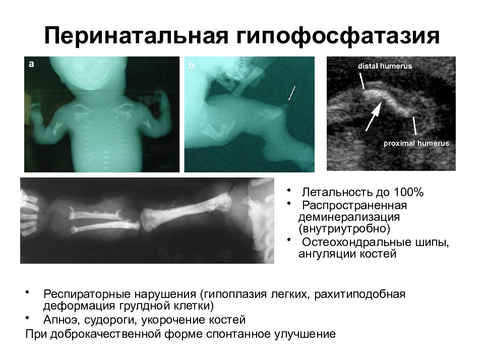 Укорочение трубчатых костей. Гипофосфатазия клинические рекомендации. Гипофосфатазия у детей клинические рекомендации. Гипофосфатазия у детей симптомы. Классификация гипофосфатазии.