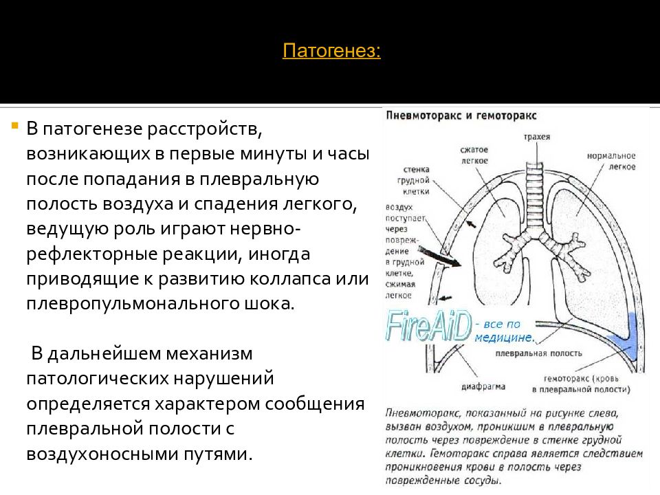 Спонтанный пневмоторакс презентация