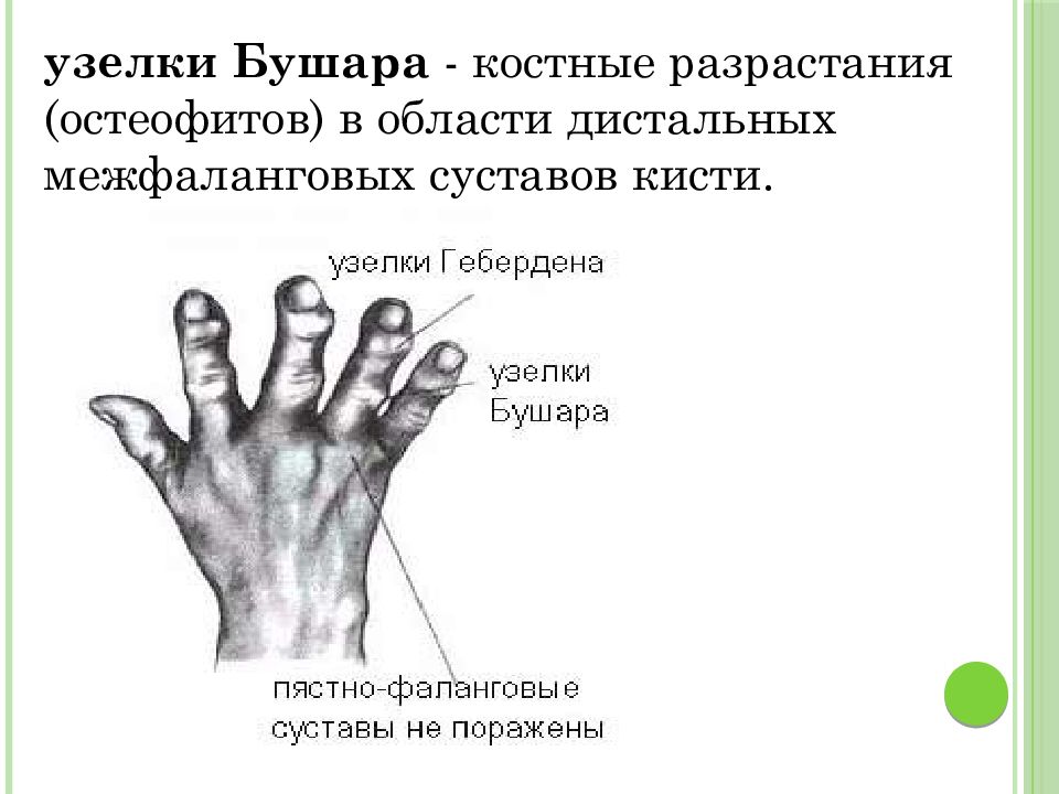 Проксимальные межфаланговые суставы кисти фото