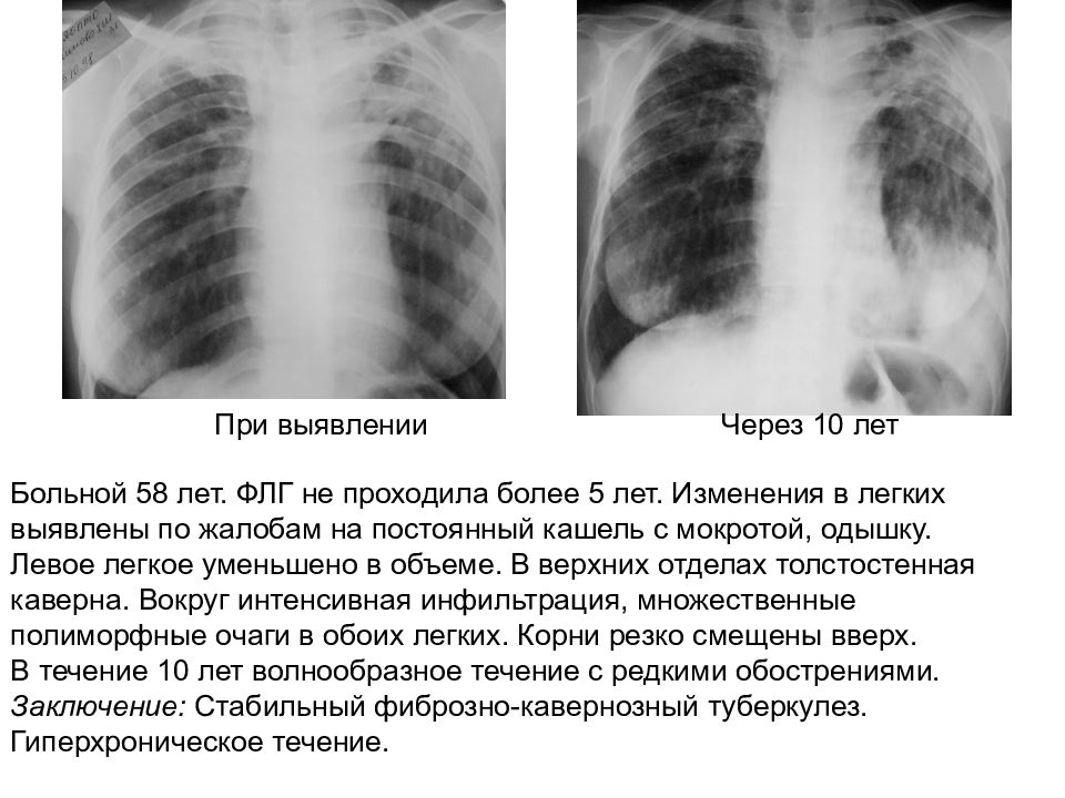 Туберкулез органов дыхания. Фиброзные изменения в легких на флюорографии. Остаточные поствоспалительные изменения в легких. Цирротический туберкулез. Поствоспалительные изменения в легких что это
