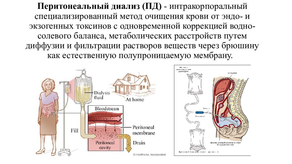 Перитонеальный диализ схема