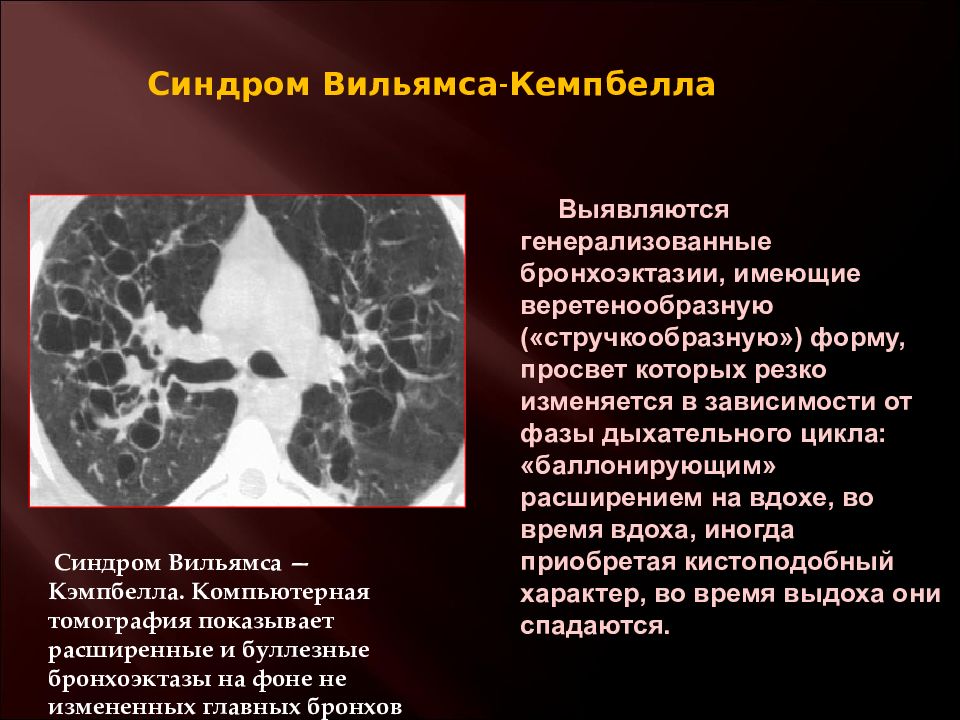 Врожденные пороки развития бронхолегочной системы презентация