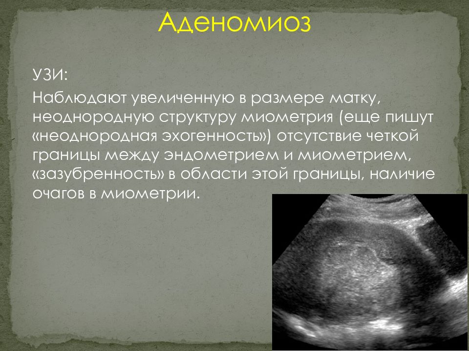 Диффузная форма матки. Узловая форма аденомиоза матки на УЗИ. Миометрий диффузно неоднородный эндометриоз. Критерии аденомиоза на УЗИ.
