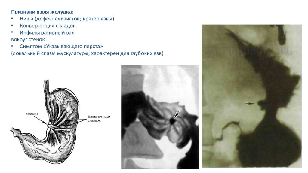 Стенка симптомы. Язвенная болезнь р скопия. Конвергенция складок желудка рентген. Симптом ниши при язвенной болезни.