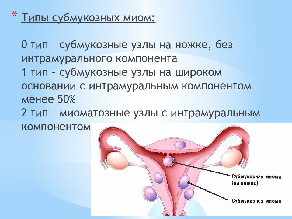 Интрамуральная лейомиома матки