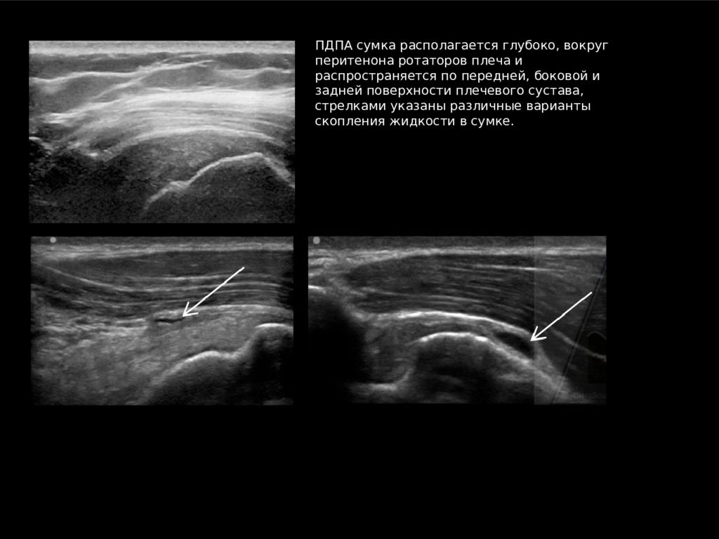Узи плечевого сустава. Протокол УЗИ плечевого сустава бурсит. УЗИ плечевого сустава норма. УЗИ левого плечевого сустава протокол. Ультразвуковая анатомия плечевого сустава.
